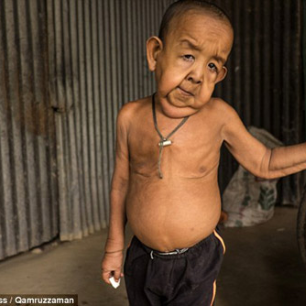 A 4yearold child in Bangladesh has an unusual illness that causes him